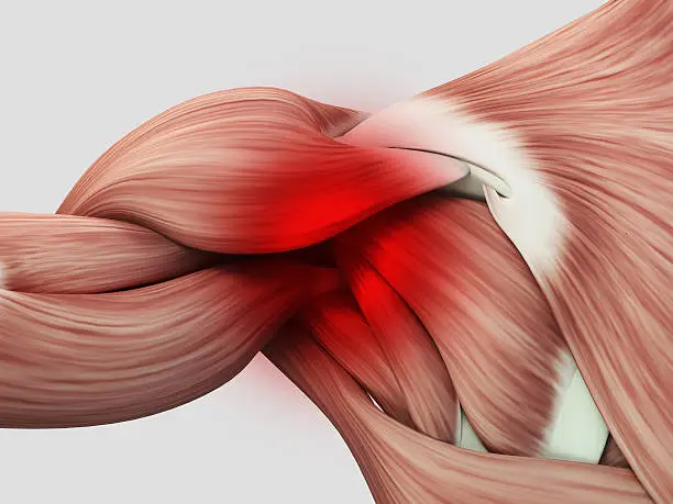 이두건염 증상과 치료법, 회복 기간은 얼마나 걸리며 벤치프레스 하다가 이두건염이 의심된다면 어떻게 해야 할까요? 어깨 통증이 심한 이두건염은 자연치유가 될까요? 글을 참고해주세요!