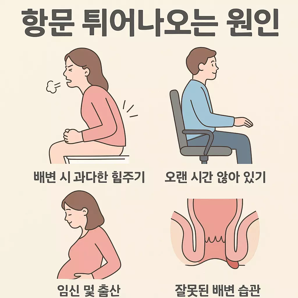 항문 튀어나오는 원인’이라는 제목 아래, 네 가지 대표 원인을 일러스트와 함께 설명한 인포그래픽. 왼쪽부터 변비로 인한 과도한 힘주기, 오래 앉아 있는 습관, 임신 및 출산, 잘못된 배변 자세를 각각 아이콘 스타일의 그림과 한글 텍스트로 표현해 항문 돌출 증상의 주요 원인을 시각적으로 이해하기 쉽게 보여줌