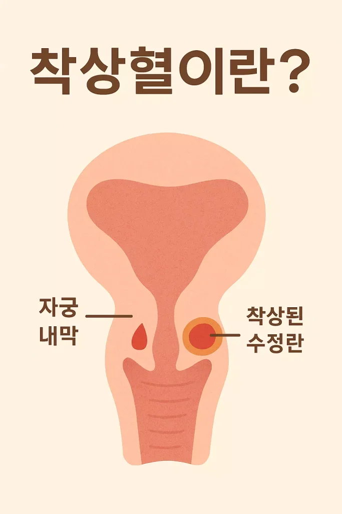 자궁 내막에 착상된 수정란과 착상혈을 보여주는 단면 일러스트